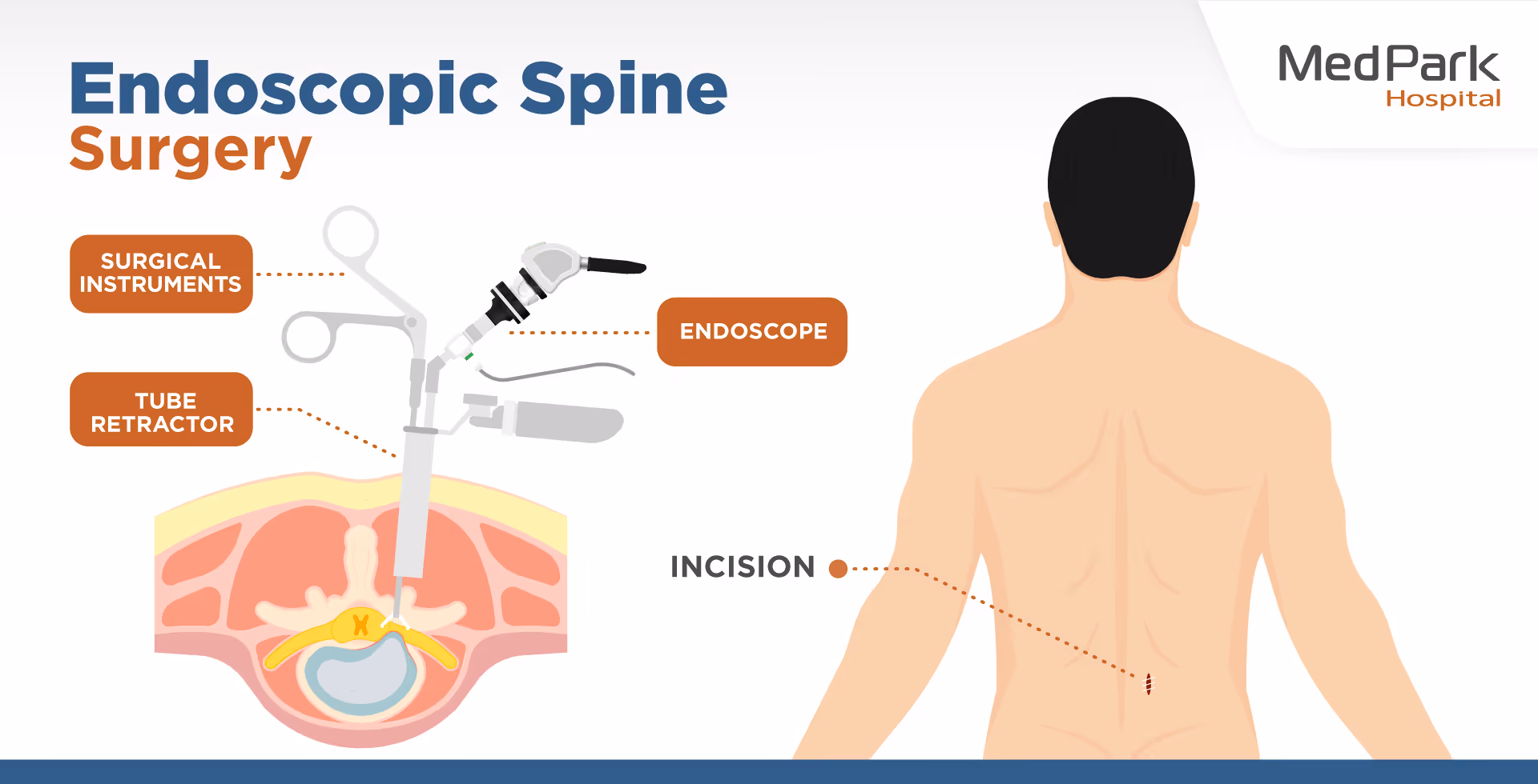 Endoscopic spine surgery procedure