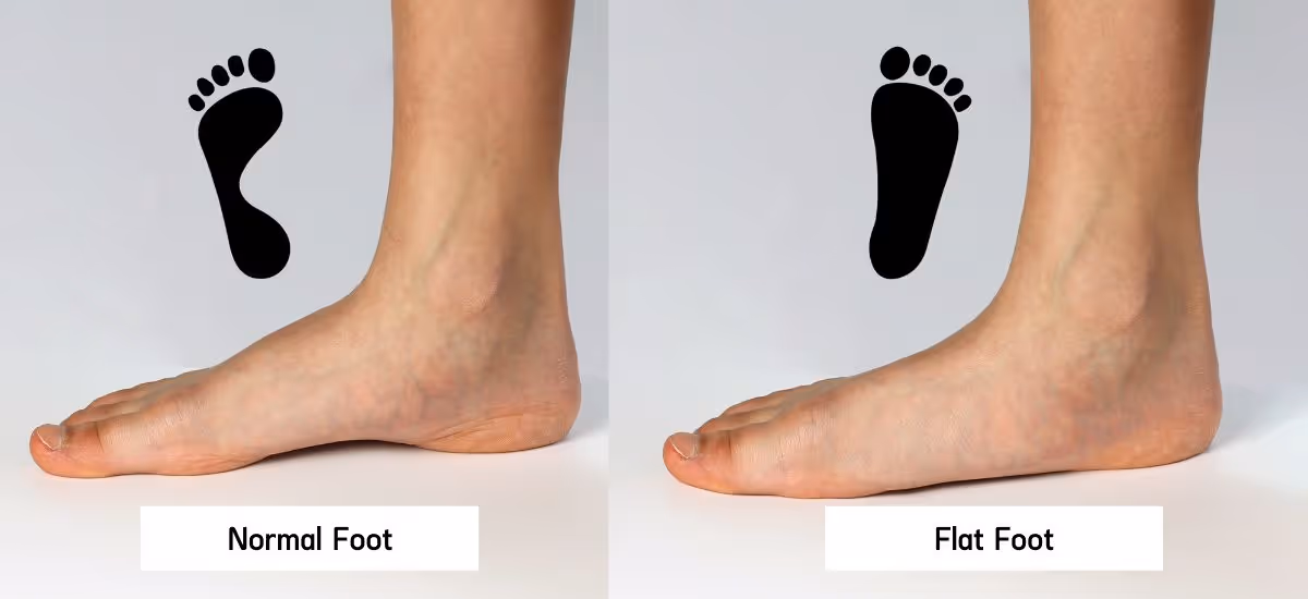 Flat Feet (flatfoot)