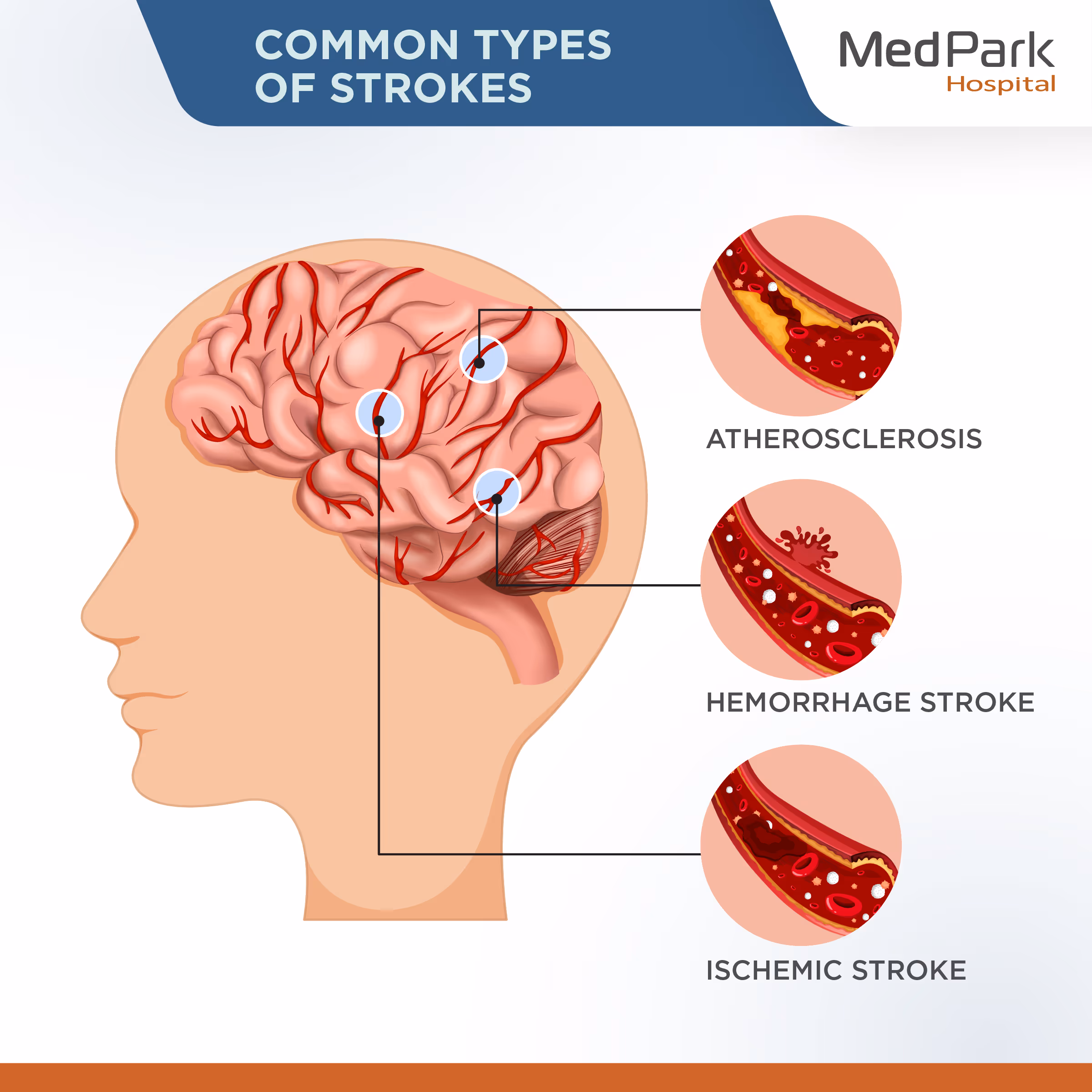 Common Types of Stroke EN