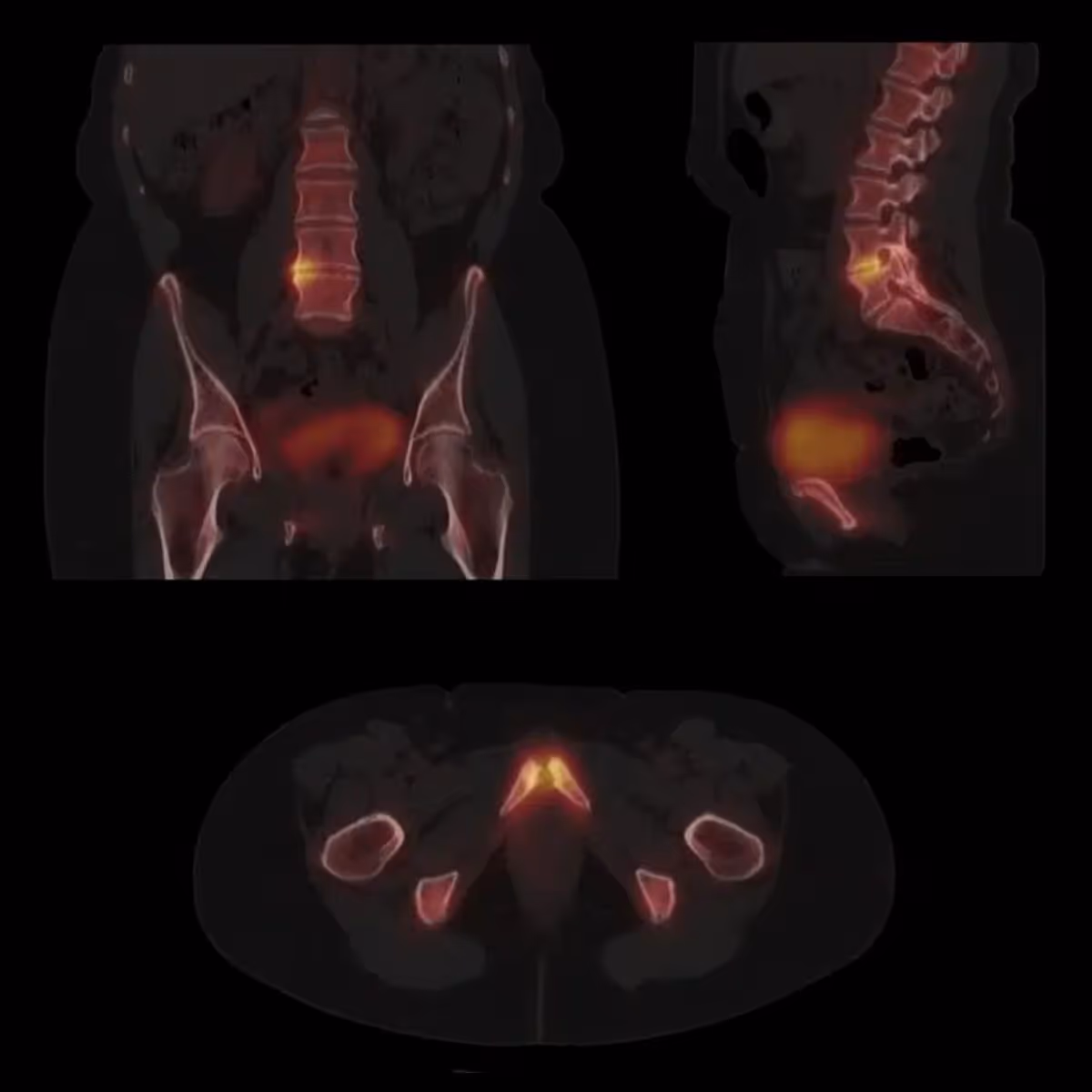 Symbia Intevo Skeletal Pathology