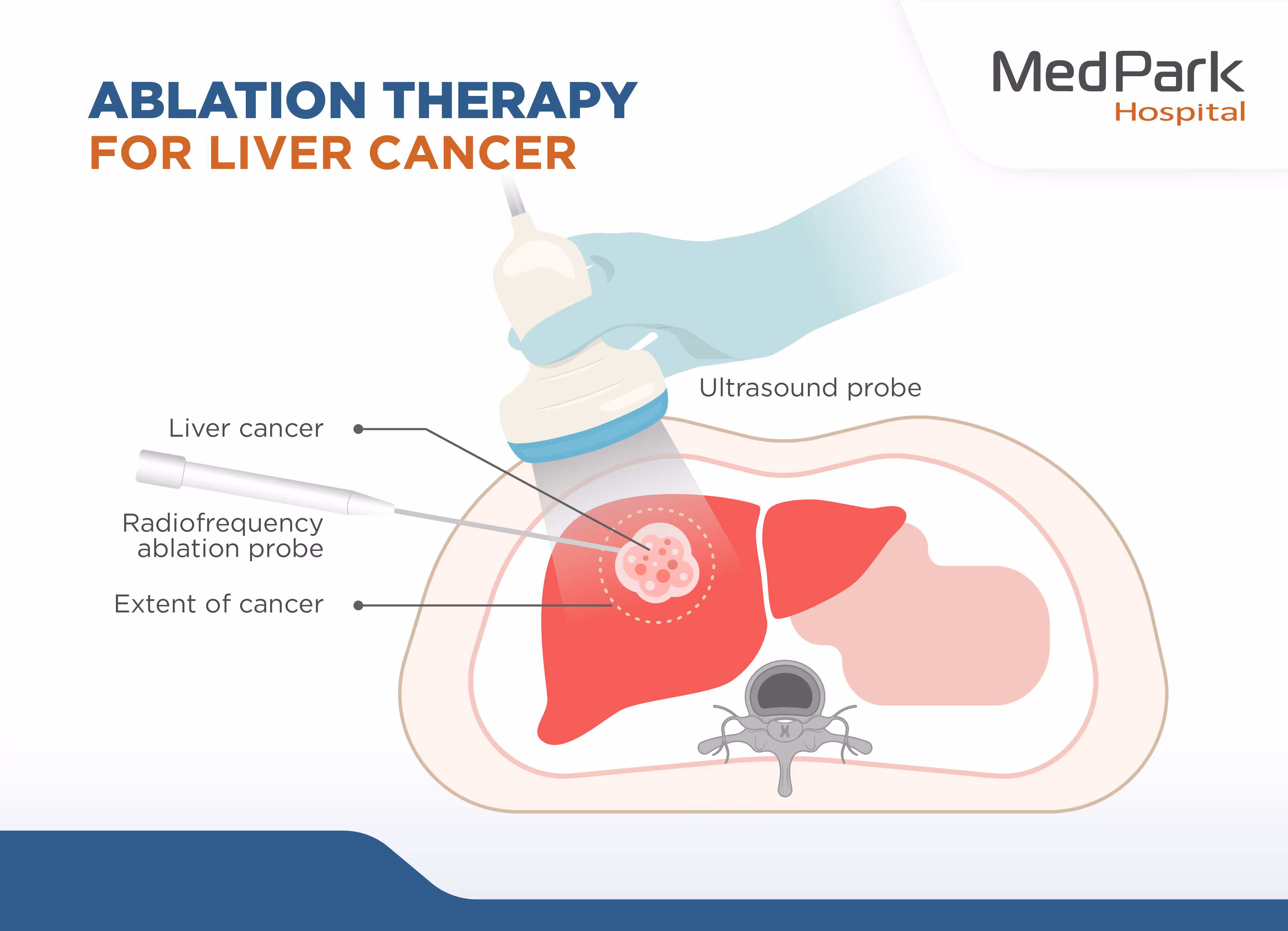 What is the procedure for ablation therapy for liver cancer?