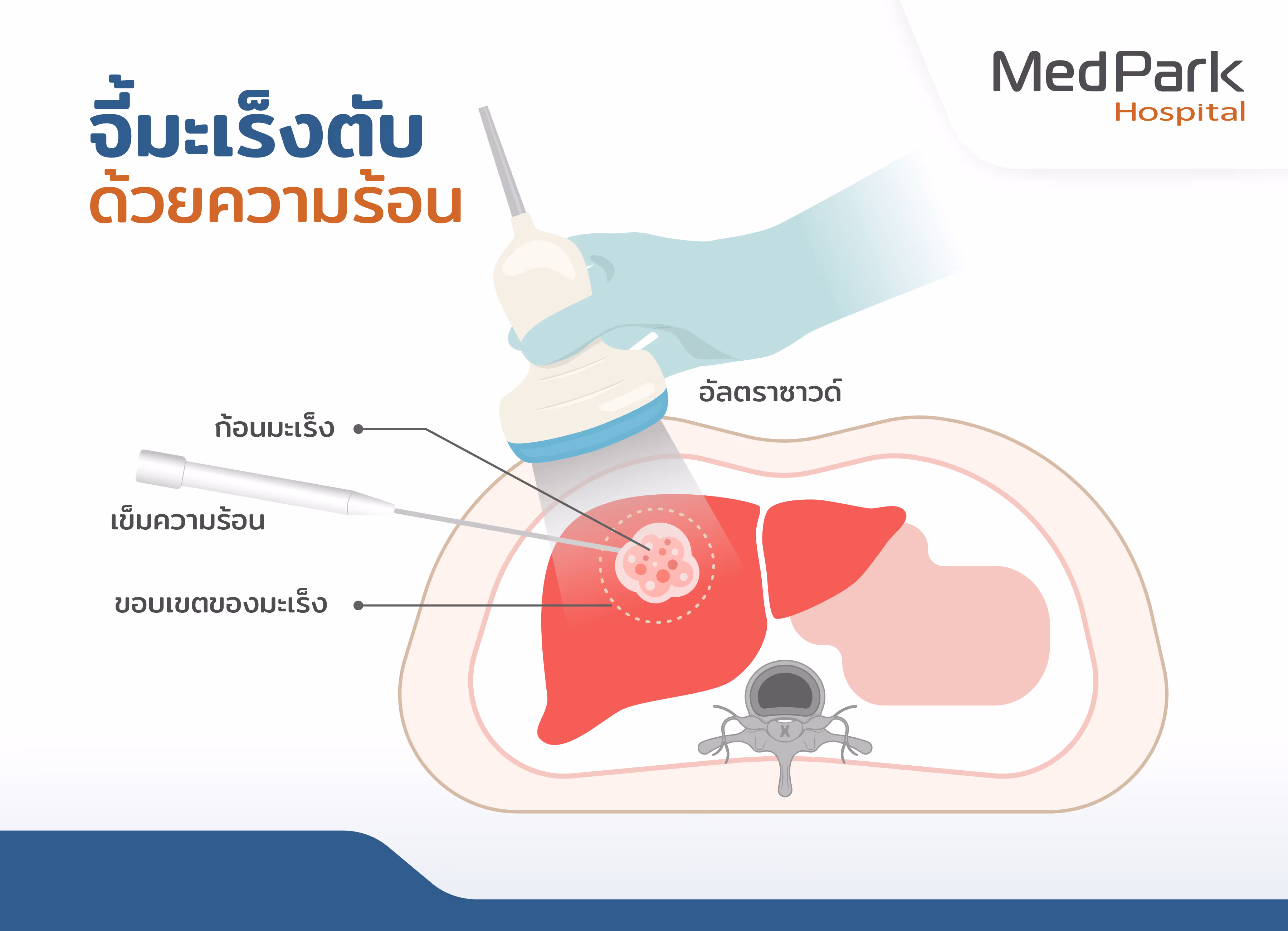ขั้นตอนการรักษามะเร็งตับโดยการจี้ความร้อน