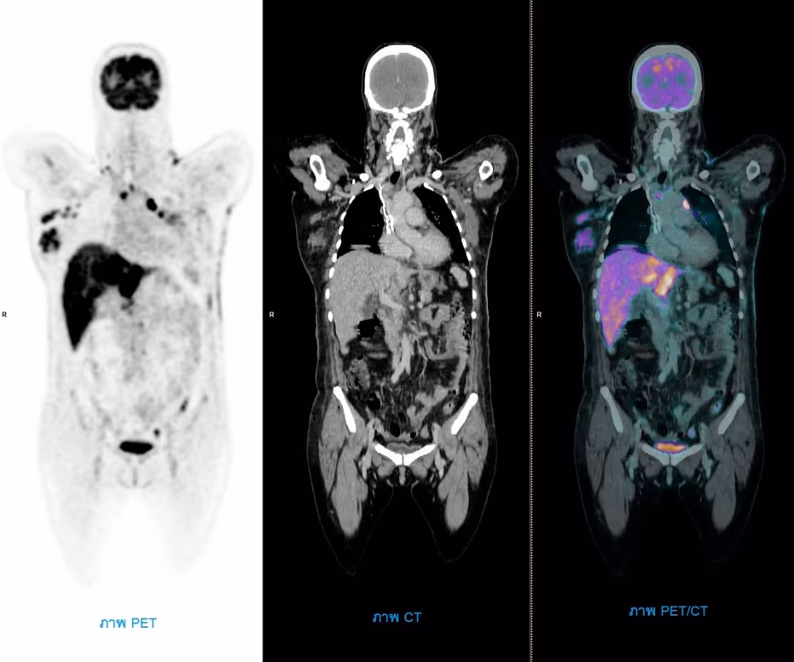 Pet Ct Scan