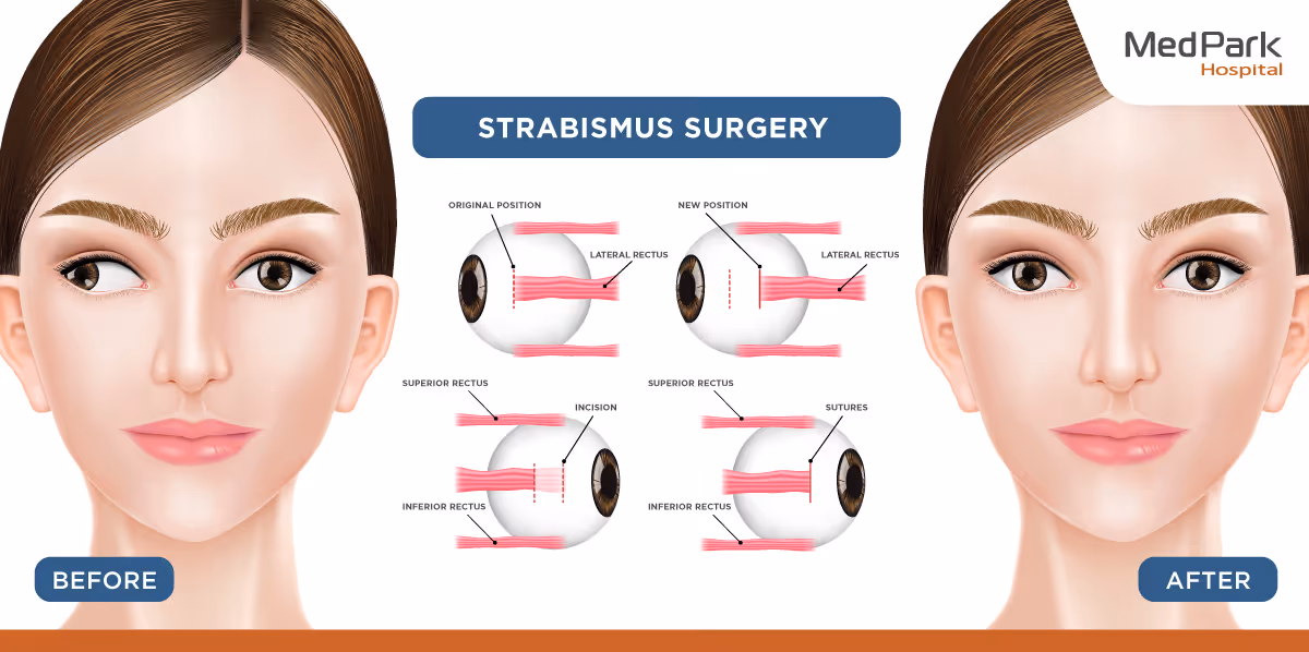 The Strabismus Surgery Procedure