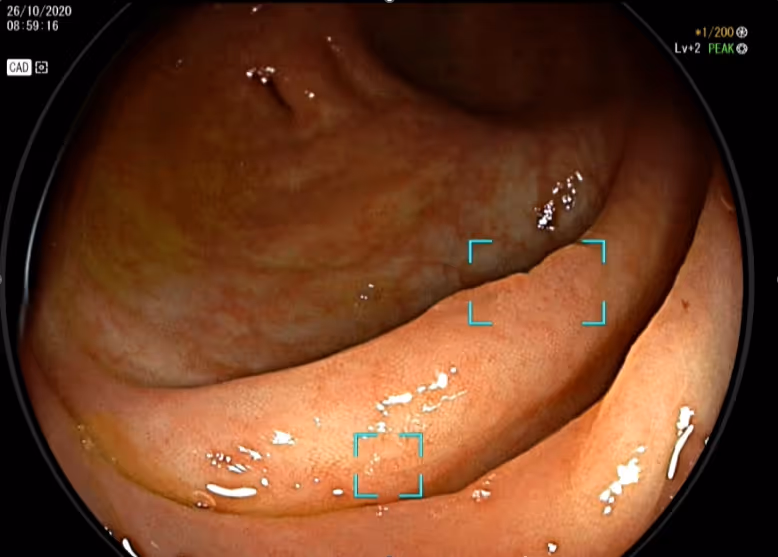 An example of DeepGI endoscopy, enhanced with AI technology, which assists physicians in detecting and alerting them to malignant polyps