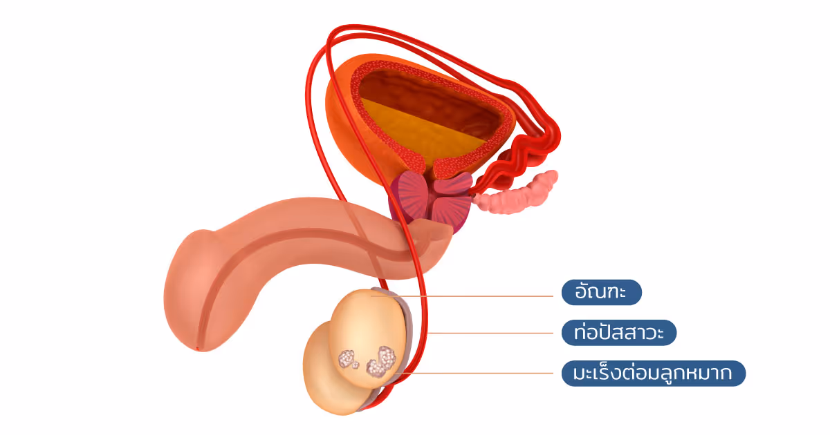 Prostate Brachytherapy Types Th