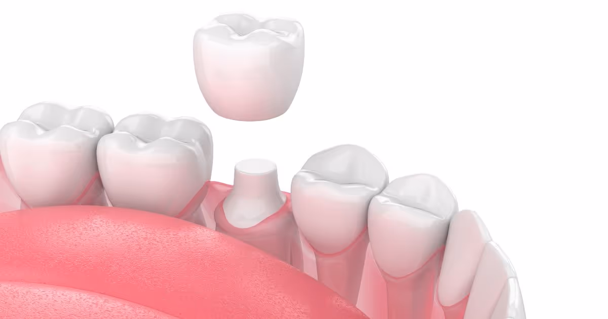 ครอบฟันวันเดียว มีขั้นตอนอย่างไร What is the one visit crown procedure?