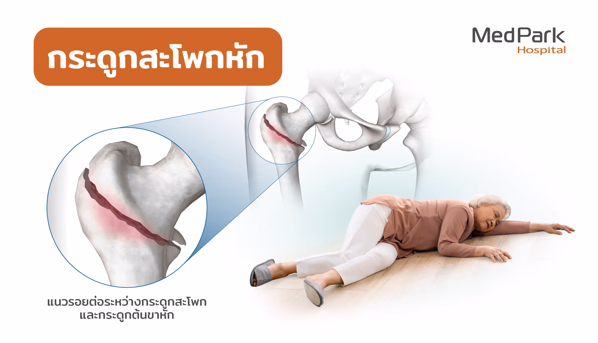 กระดูกสะโพกหักในผู้สูงอายุ สาเหตุจากอะไร What causes hip fractures in the elderly?