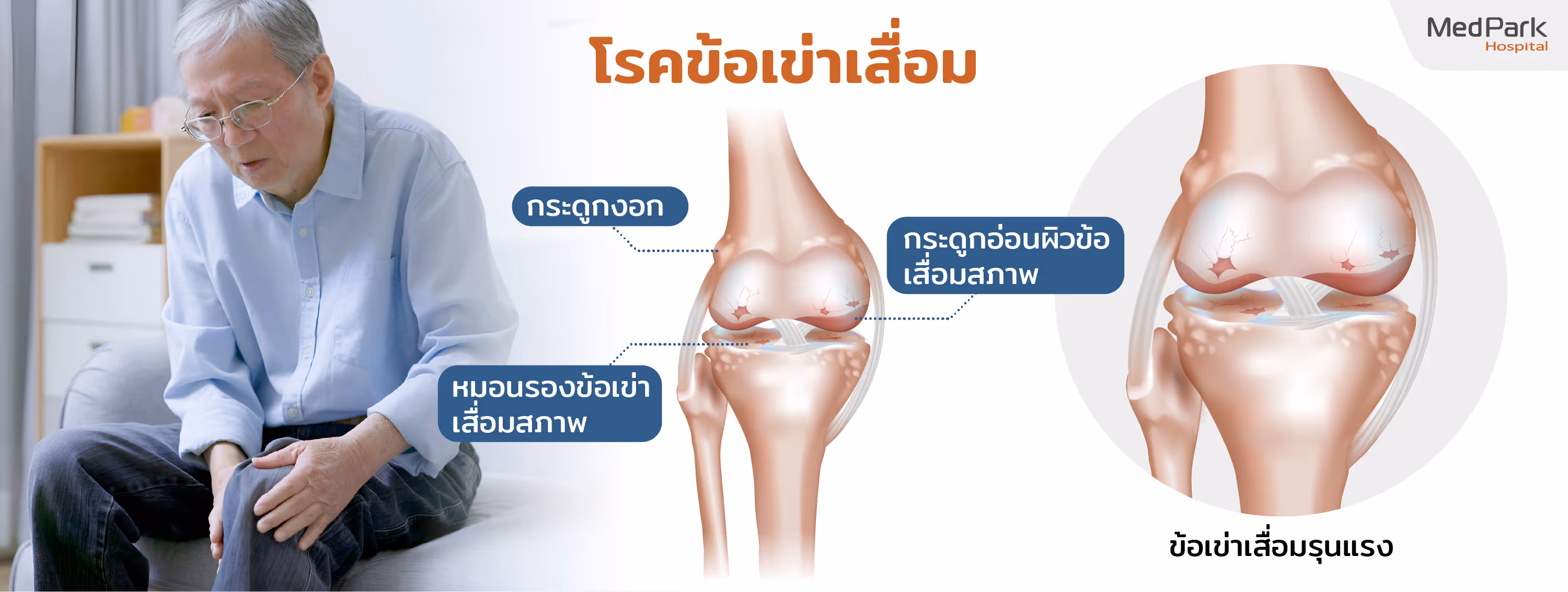 โรคข้อเข่าเสื่อม ระยะรุนแรง Severe knee osteoarthritis