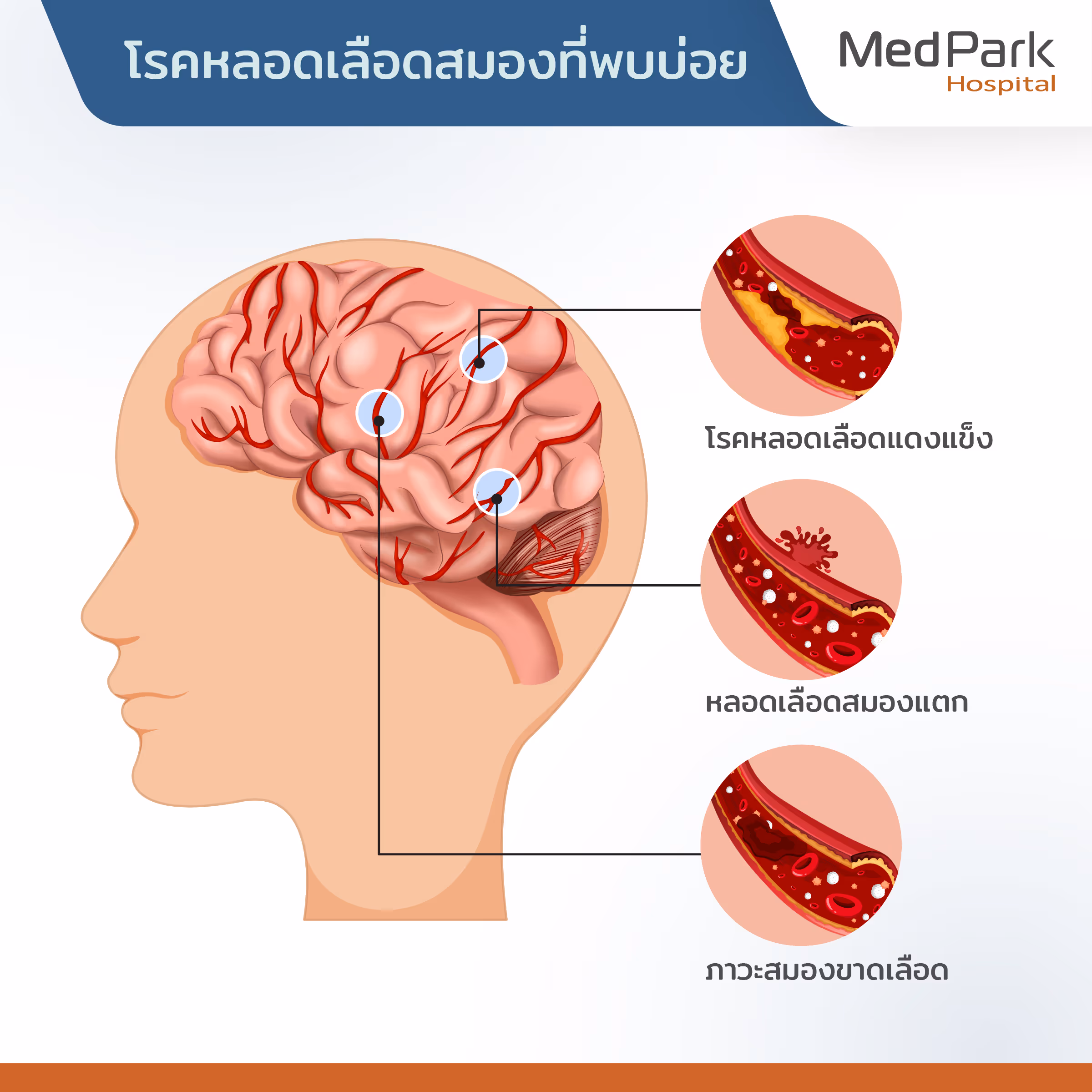 Common Types of Stroke Th