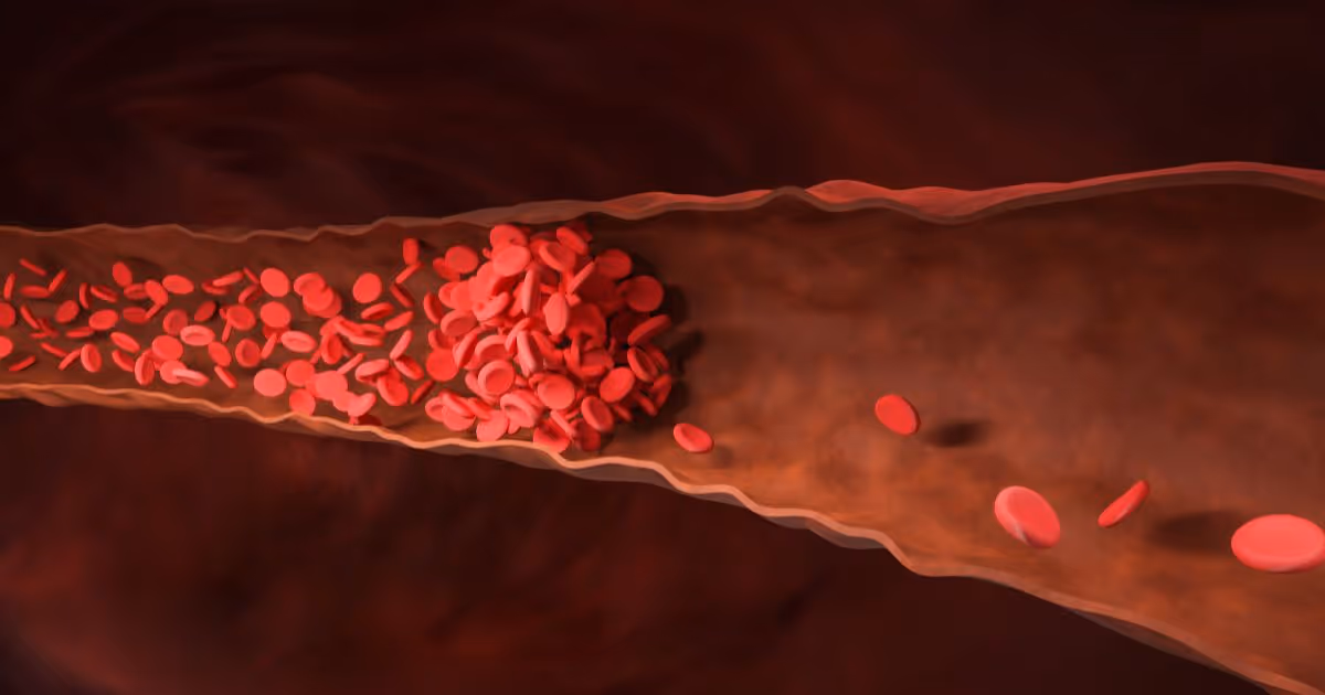 Cerebral Venous Thrombosis Headache 1
