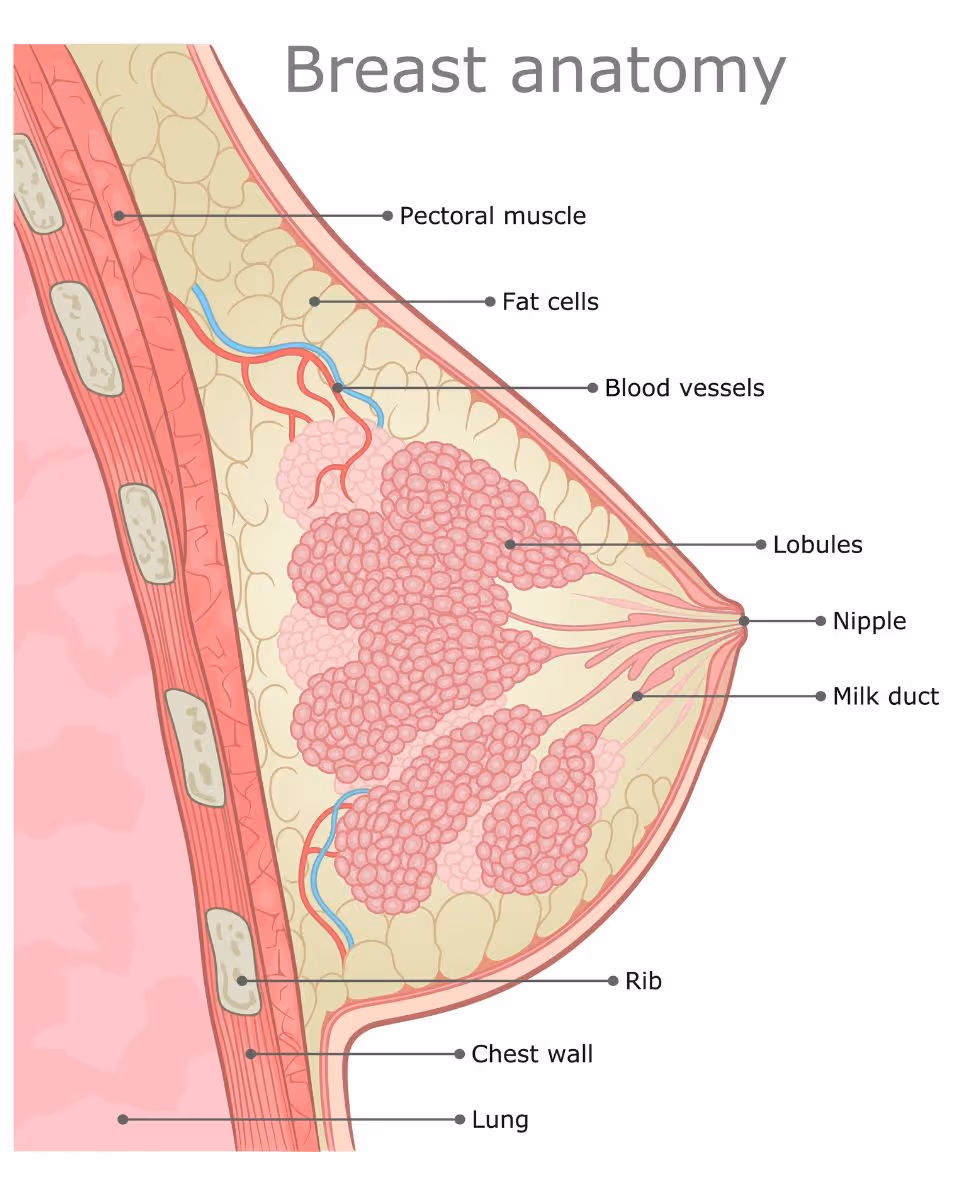 (breast Cancer, Carcinoma of the Breast 2
