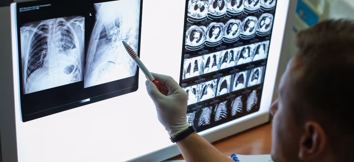 การตรวจเอกซเรย์คอมพิวเตอร์ทรวงอก (Chest CT Scan)