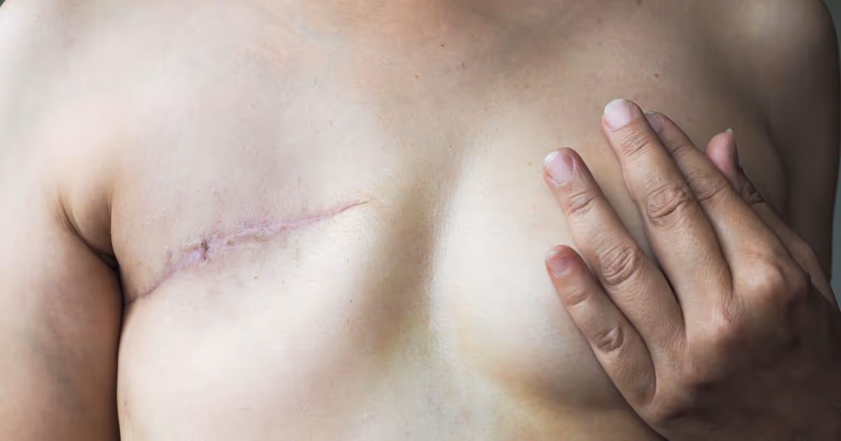 Evolution and Treatment of Breast Cancer by Stage 7