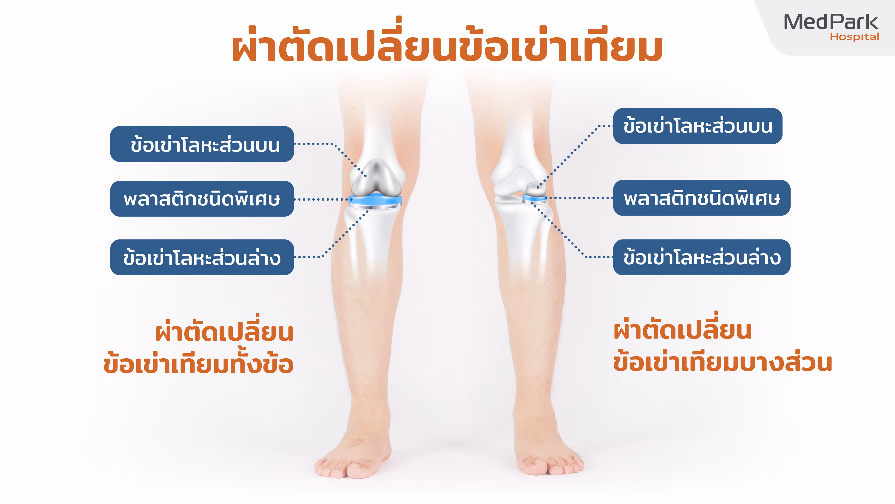 ขั้นตอนการผ่าตัดเปลี่ยนข้อเข่าเทียมทั้งข้อ Total knee replacement procedure