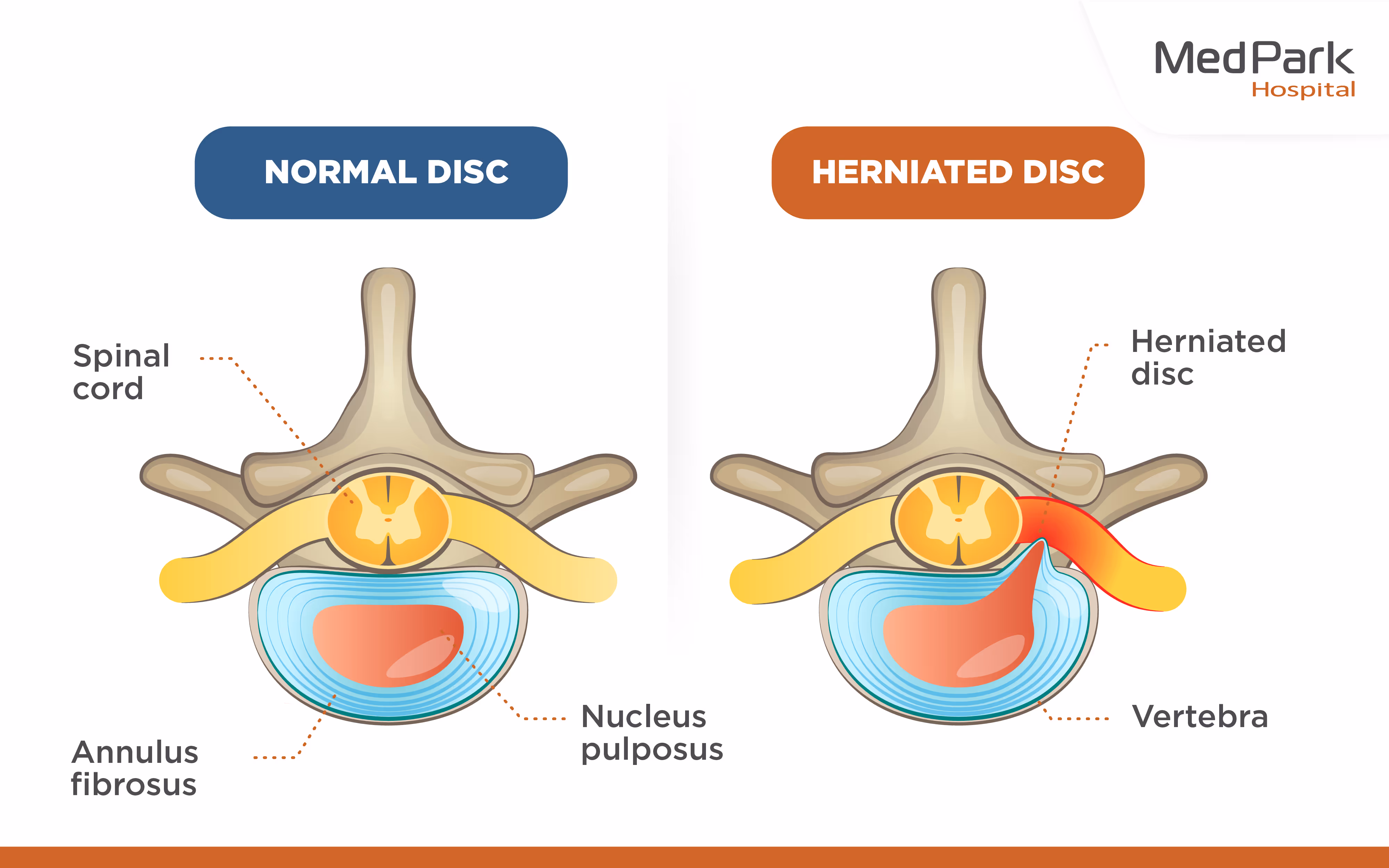 Endoscopic spine surgery can effectively treat the following conditions: Herniated disc, Spinal stenosis, and Degenerative disc disease