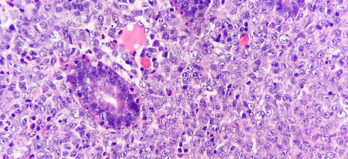 ภาพเซลล์มะเร็งขนาดใหญ่ มะเร็งต่อมน้ำเหลือง (Lymphoma) 