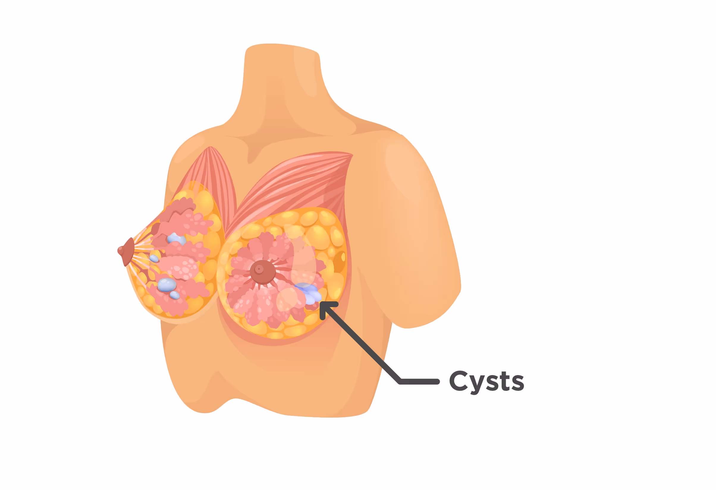 ซีสต์เต้านม ตำแหน่งในเต้านมที่มีซีสต์ ซีสต์ที่อยู่ในเต้านม