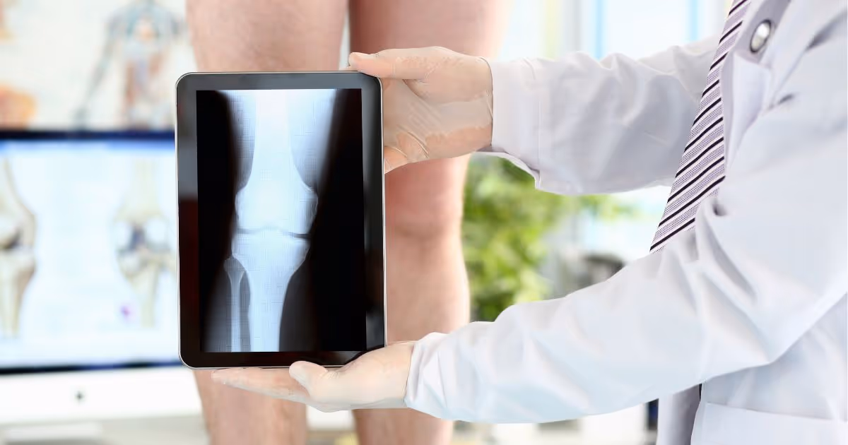 Acl Reconstruction 2