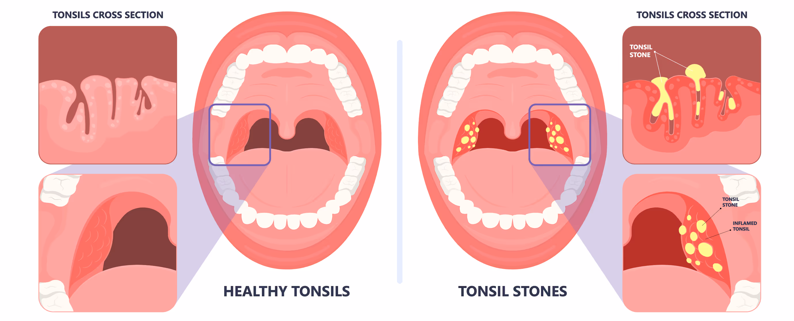 ต่อมทอนซิลที่ปกติ และต่อมทอนซิลที่อักเสบ - Healthy tonsillitis and Tonsillitis stones