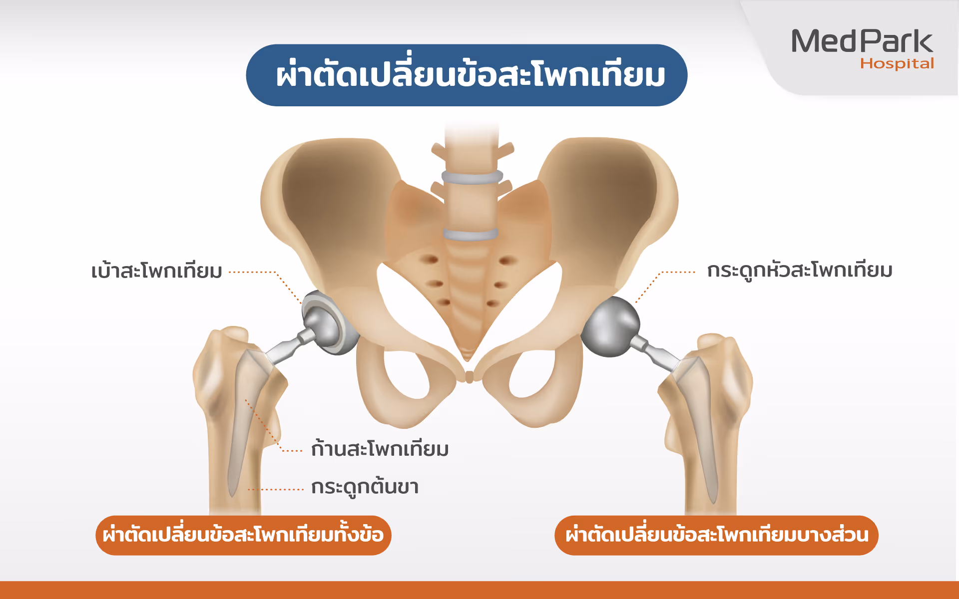 Hip Replacement Th 2