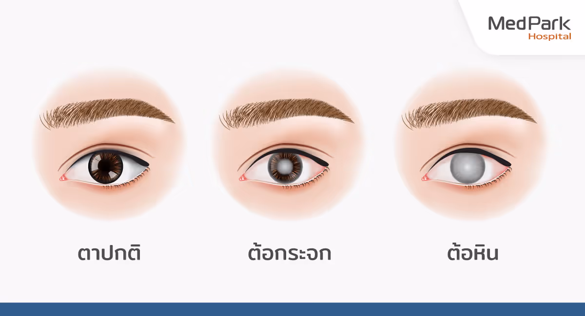 ต้อกระจก เกิดจากอะไร-What causes cataracts