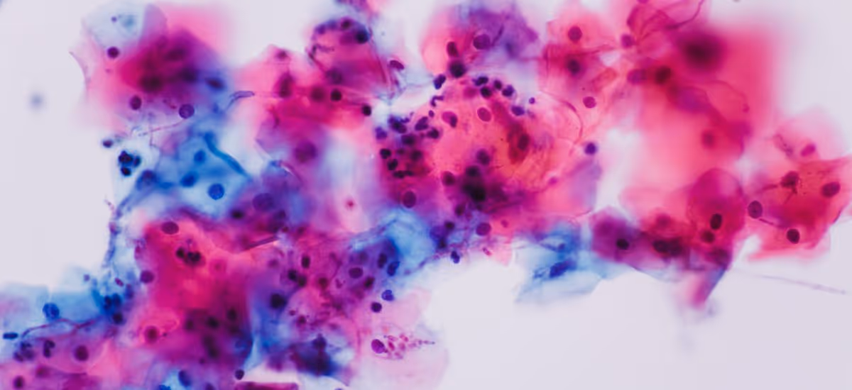 Vaginal Yeast Infection Banner 4