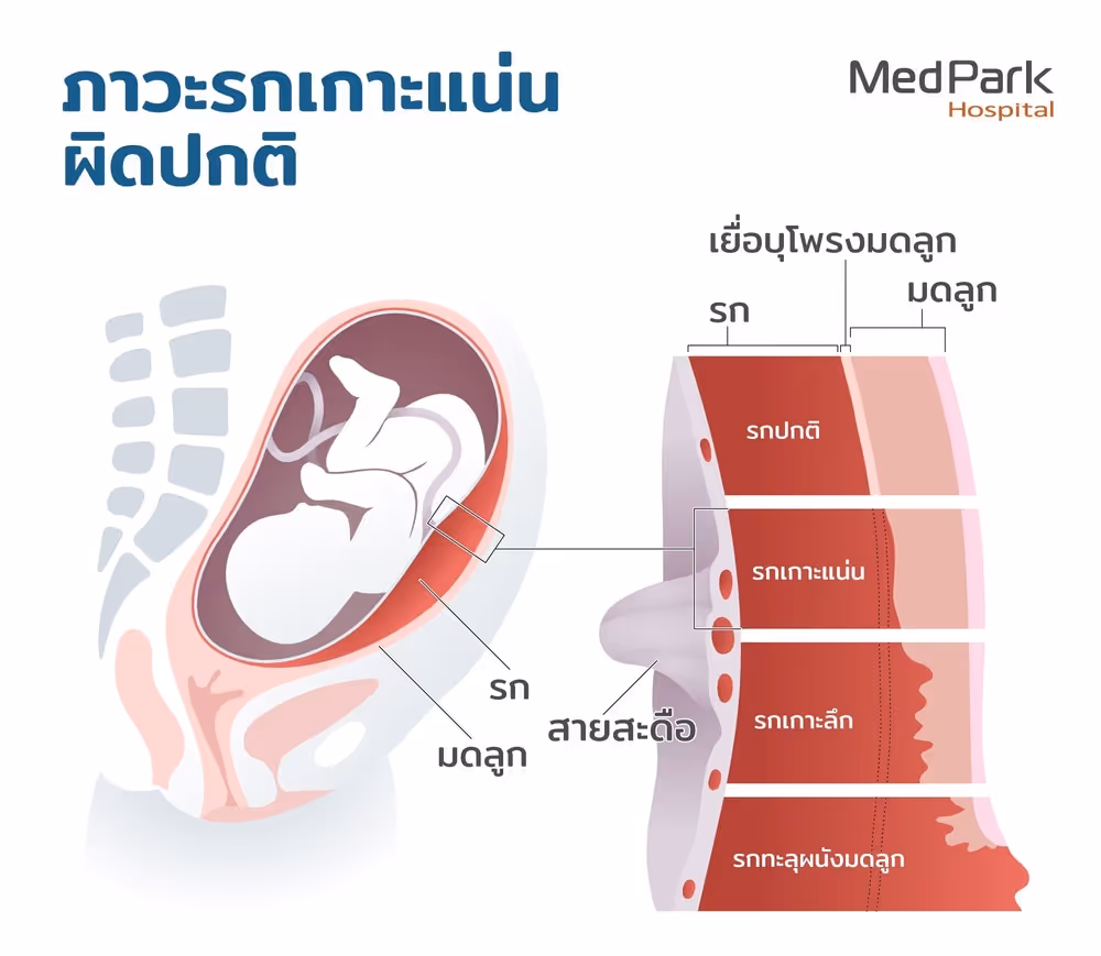ภาวะรกเกาะแน่นผิดปกติ รกเกาะลึก รกทะลุผนังมดลูก