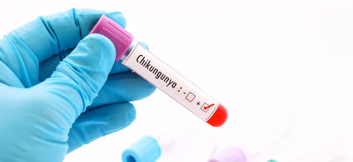 การตรวจวินิจฉัยโรคไข้ชิคุนกุนยา