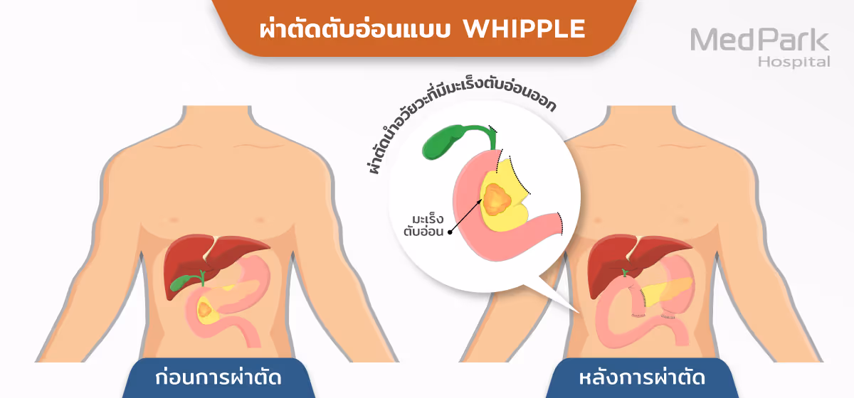Pancreatectomy 02