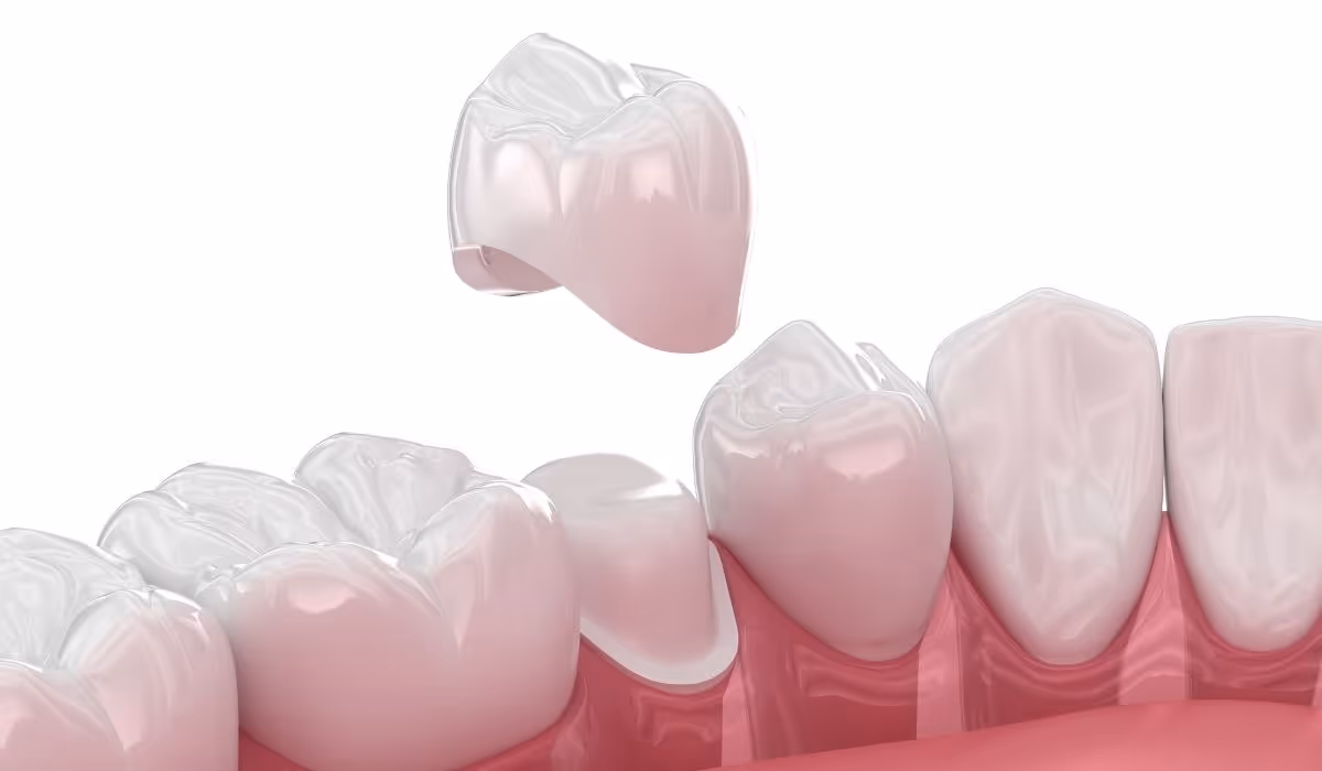 Dental Crown Banner 8