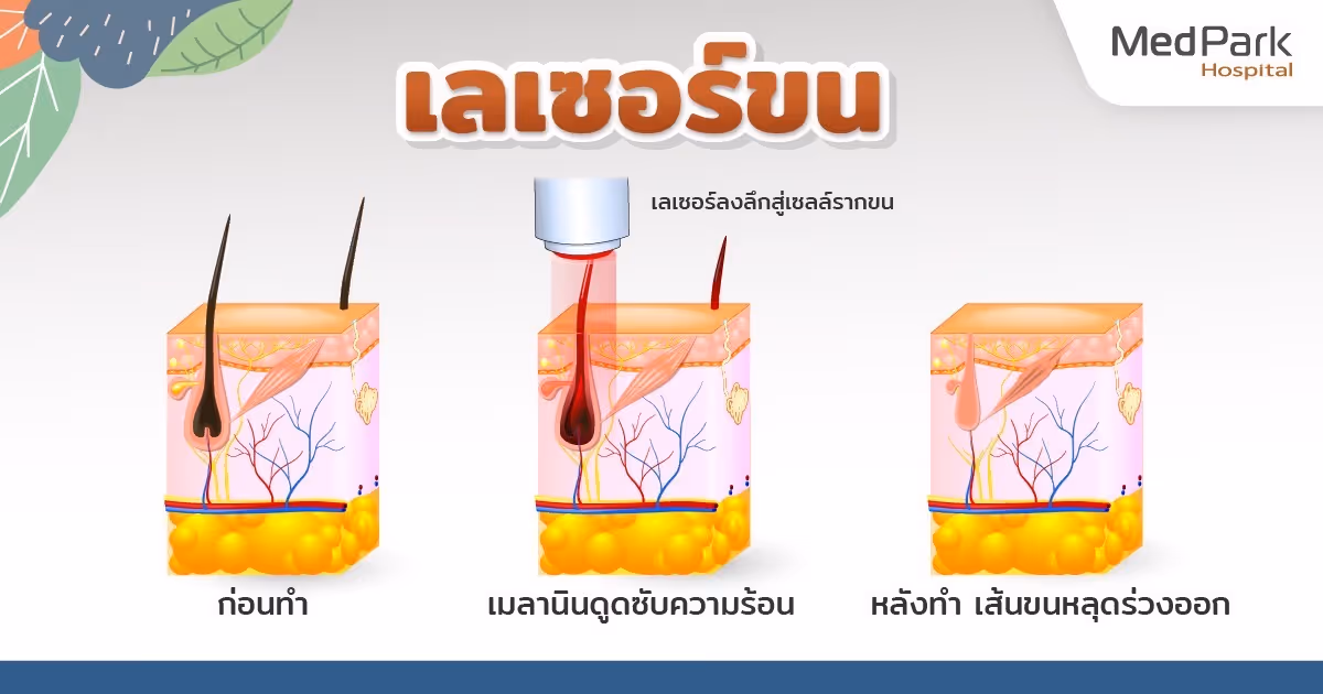 เลเซอร์ขน เหมาะกับใคร
