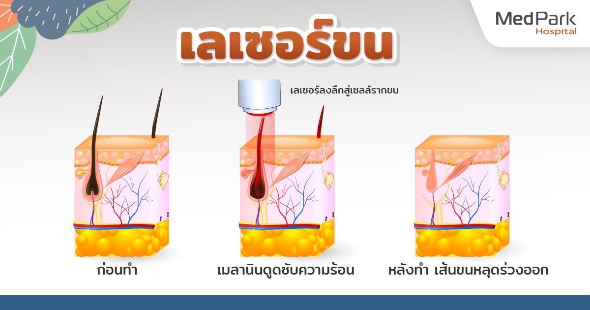 เลเซอร์ขน เหมาะกับใคร