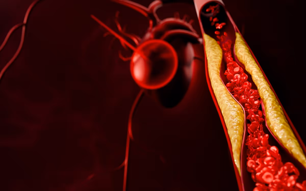 Coronary Artery Disease