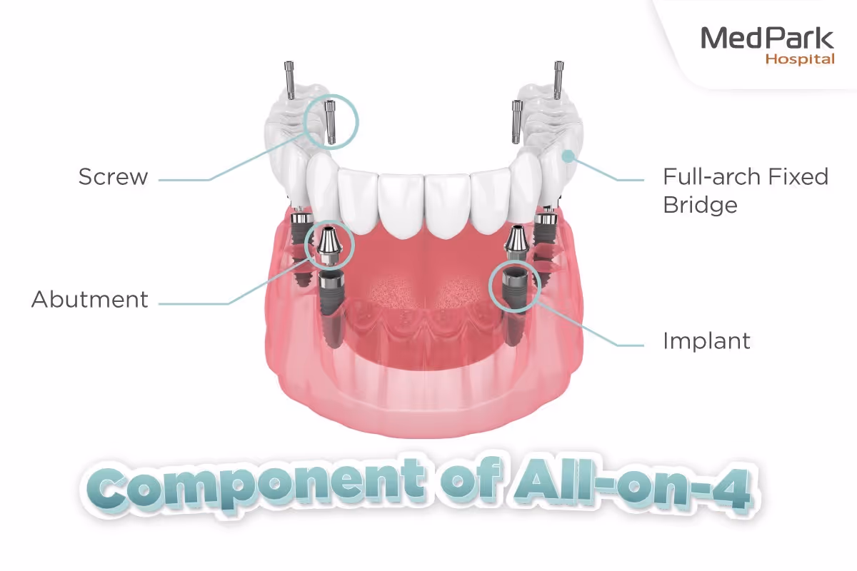 Component of All on 4 Dental Implants