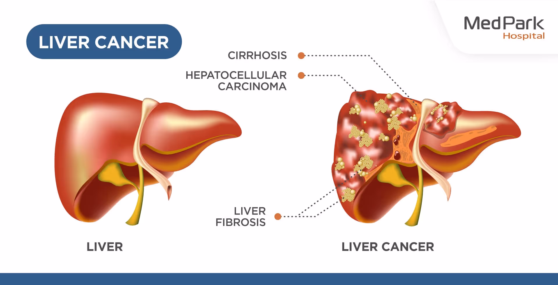 Y 90 Radioembolization for Liver Cancer En (1)