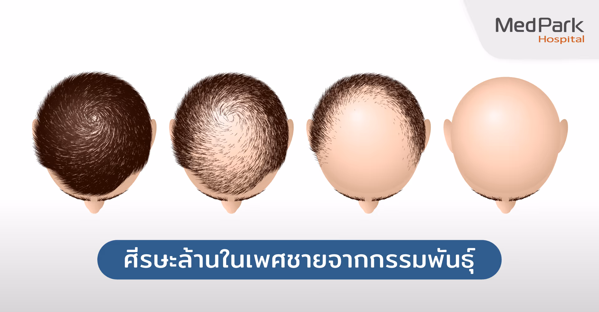 ปลูกผม FUE เหมาะกับใคร