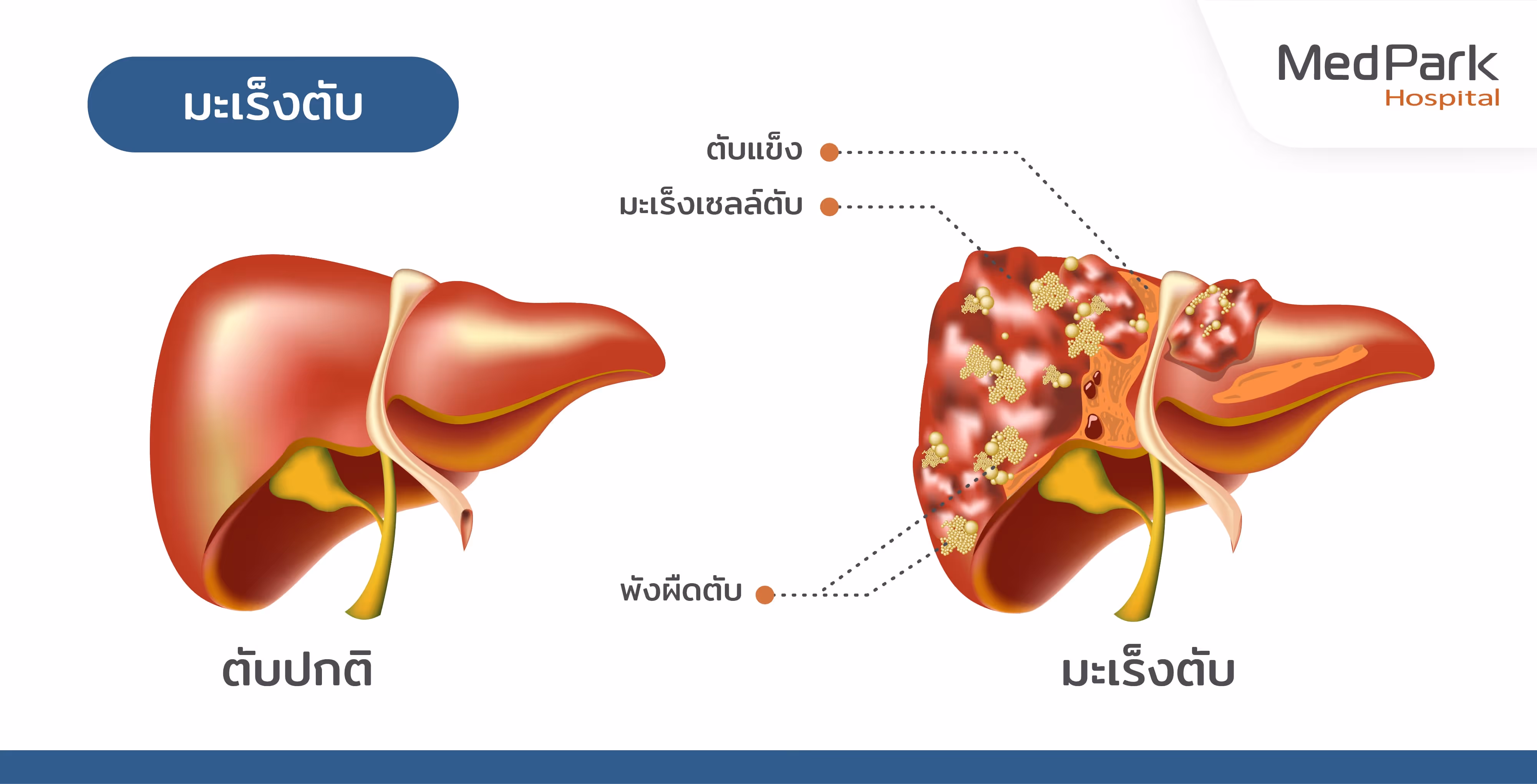 Y 90 Radioembolization for Liver Cancer Th (1)