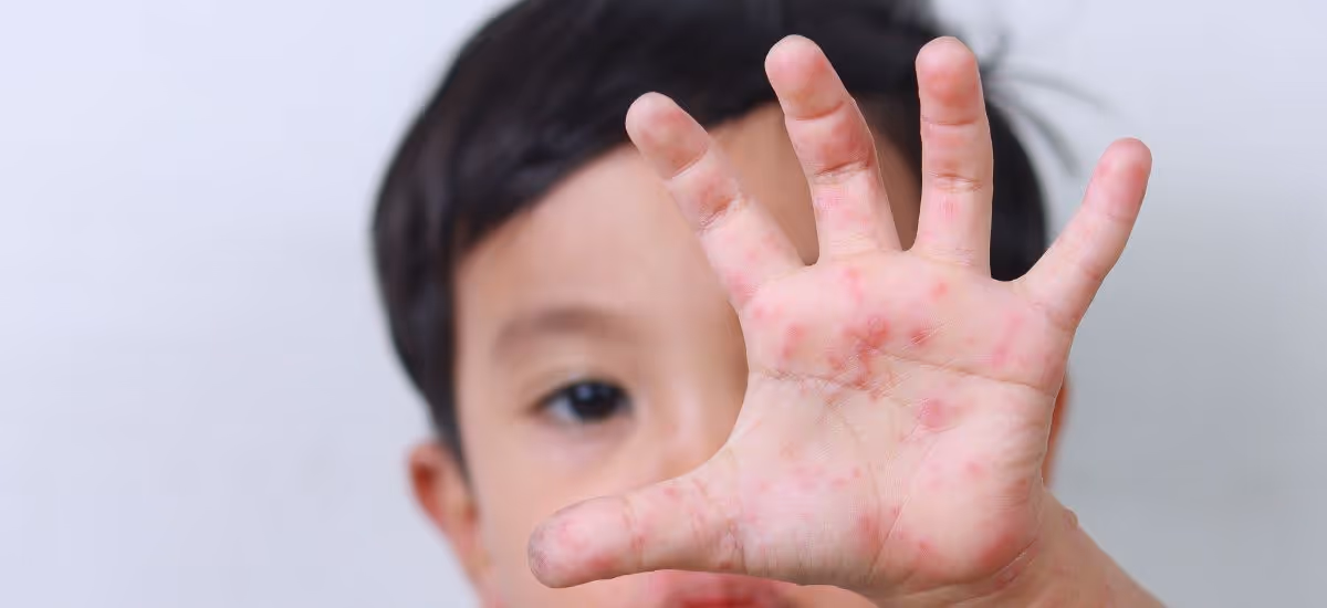 Hand, Foot, and Mouth Disease - Symptoms, Causes, Diagnosis, Treatment and Prevention