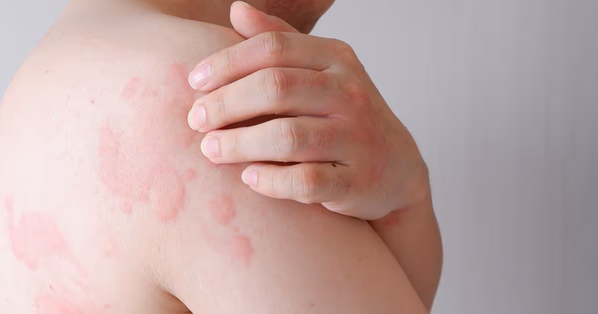 the symptoms of aquagenic urticaria