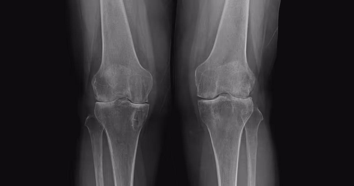 อาการปวดเข่ามีสาเหตุเกิดจากอะไร - What causes of knee pain?