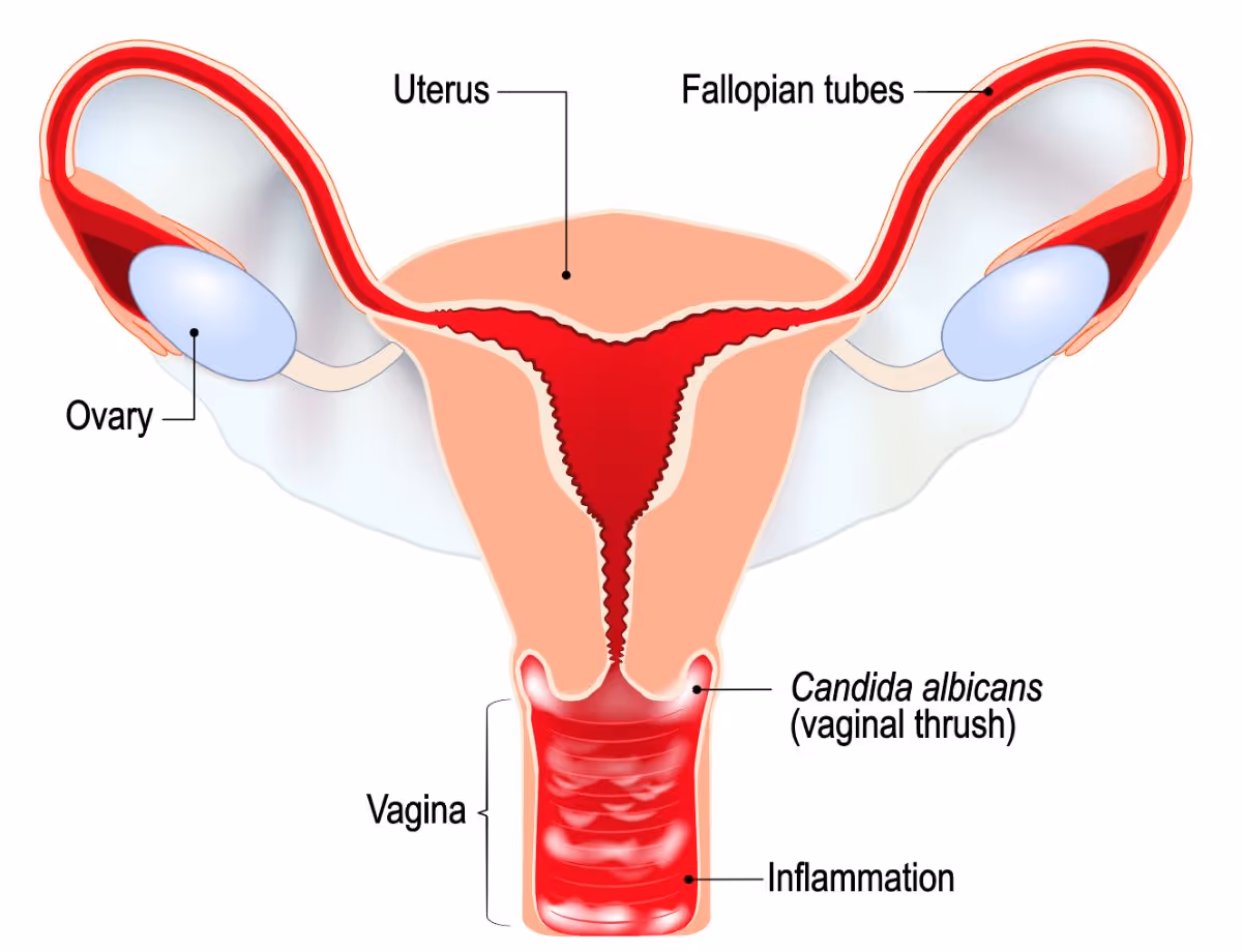 Vaginal Yeast Infection Banner 3