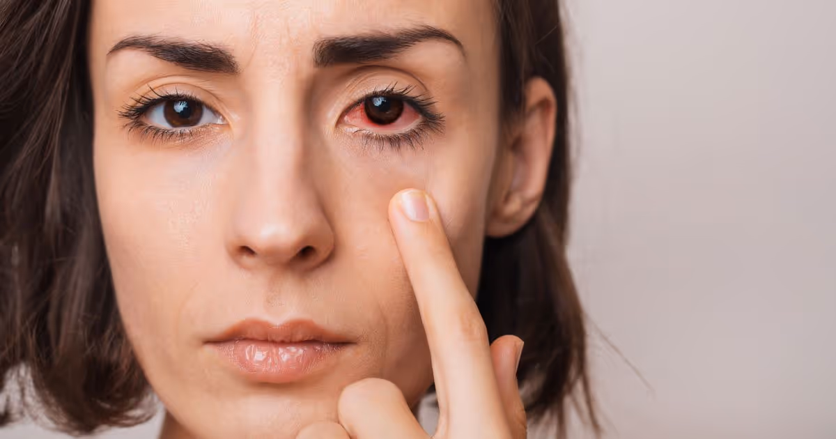 สาเหตุ อาการ วิธีรักษาม่านตาอักเสบ - Causes, Symptoms, Treatment of Uveitis