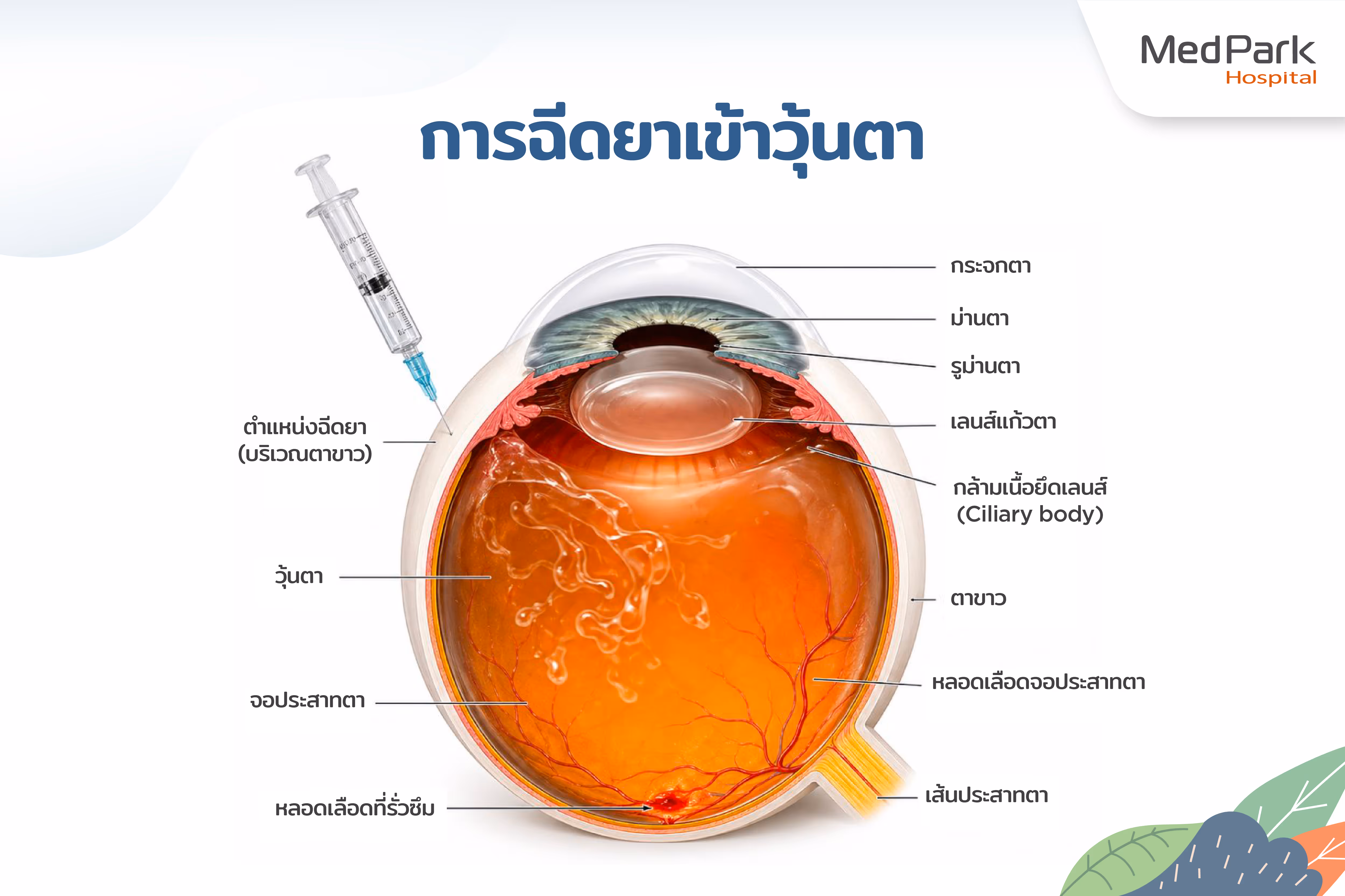การฉีดยาเข้าวุ้นตา (intravitreal Injection) Th