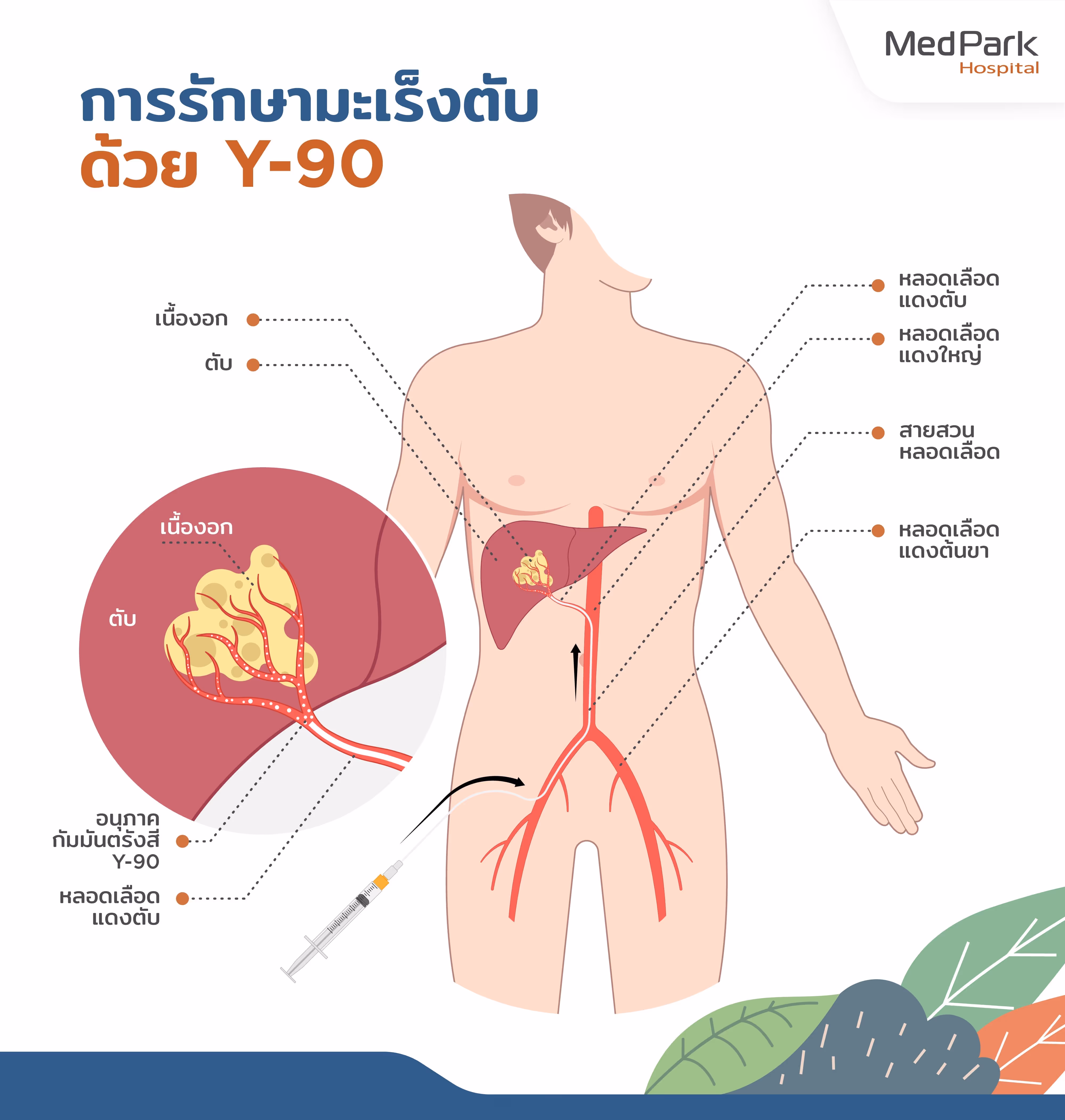 Y 90 Radioembolization for Liver Cancer 4