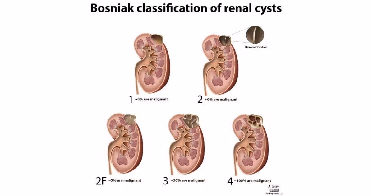 เนื้องอกที่ไต (Kidney Tumors)