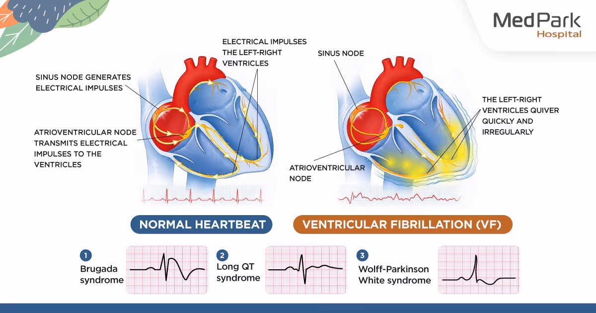 Normal heartbeat vs Ventricular fibrillation (VF)