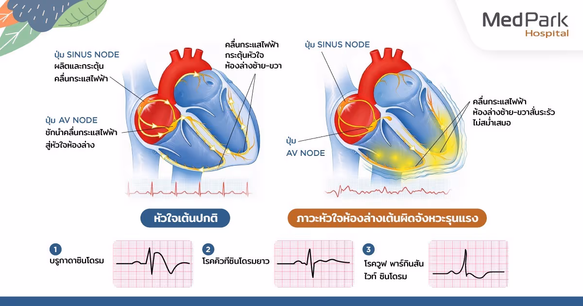 เปรียบเทียบหัวใจเต้นปกติ และหัวใจห้องล่างเต้นผิดจังหวะรุนแรง