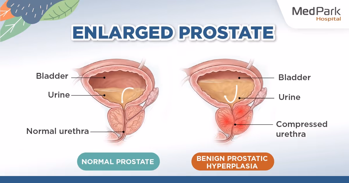 An enlarged prostate compressed the urethra