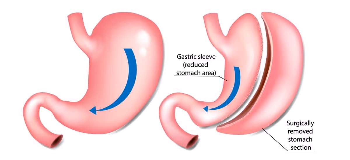 รูปการผ่าตัดแบบสลีฟ (Sleeve gastrectomy: SG)